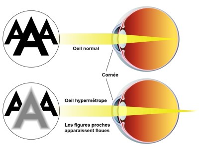 metoda de tratament hipermetropie factorii pierderii vederii