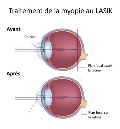 lasik-myopie