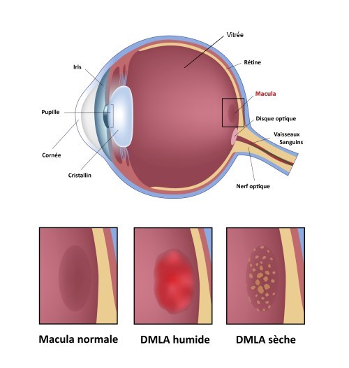 DMLA macula