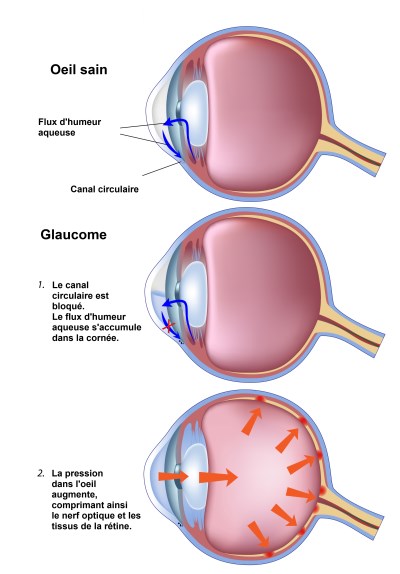 glaucome